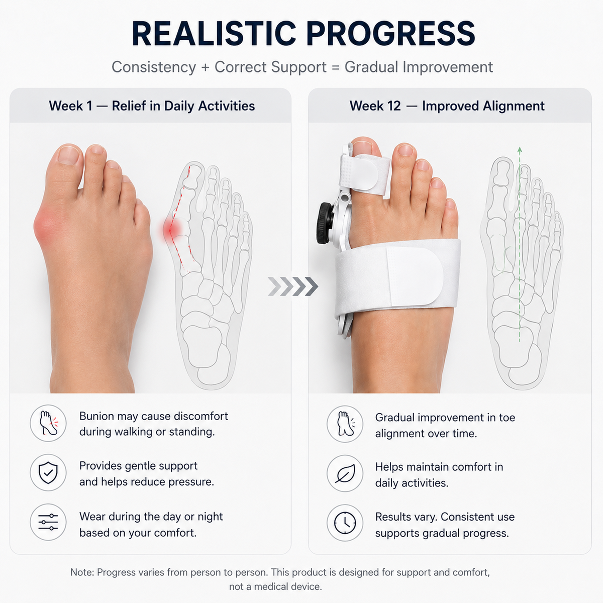RESUME™ ortopedski korektor za bunion nožnih prstiju