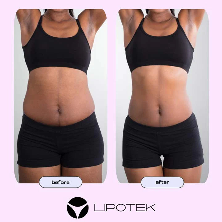 LIPO BELT™-Tvarujúci pás s technológiou EMS na zmiernenie bolesti krížov