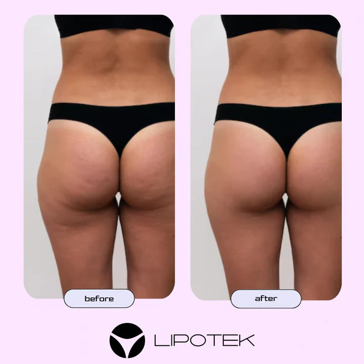 Liposhorts™ Vytvarujte si nohy a zadok